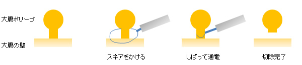 大腸ポリープ切除手術の流れ